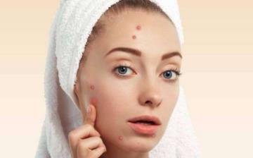 【痤瘡】痤瘡怎么治療_痤瘡和青春痘的區別_痤瘡性囊腫