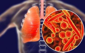 【新型冠狀病毒肺炎】新冠病毒感染肺炎早期癥狀、潛伏期、預防、治療