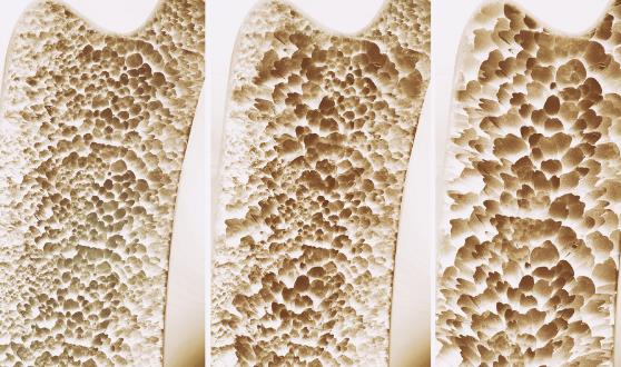 骨質疏松的10個認知誤區,你中了沒?