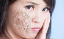 皮膚缺水的表現你中招了嗎 給皮膚正確補水還你水光肌