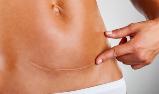 剖腹產劃破嬰兒頭 細數剖腹產的7大危害