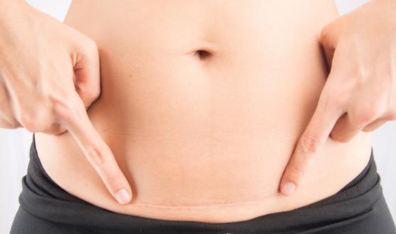 剖腹產劃破嬰兒頭 細數剖腹產的7大危害