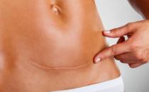 ?細(xì)數(shù)剖腹產(chǎn)的七大危害 剖腹產(chǎn)坐月子注意事項(xiàng)