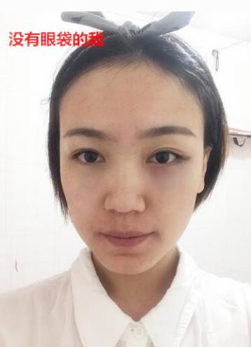 衛(wèi)婭日記：我一直都以為眼袋對我的影響只是美觀，直到我了解了以后……