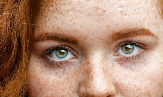 激光祛斑會(huì)不會(huì)反彈 適合激光祛斑的人群