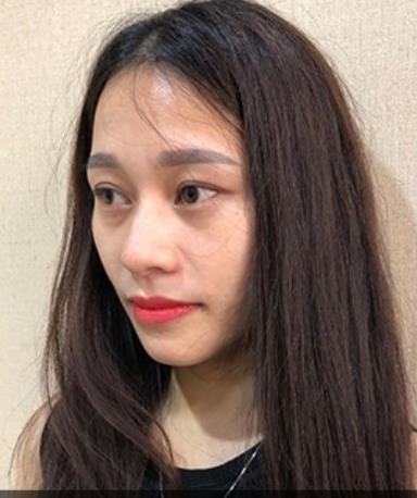 幻柔筆記:眼袋修復后氣質立現,怎么看都是青春靚麗!