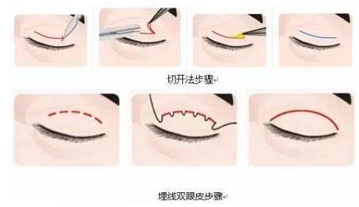上海玫瑰整形醫院雙眼皮手術怎么樣？輕松擁有靚麗雙眼