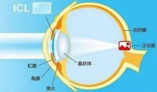 西安普瑞眼科醫院好嗎？戴眼鏡VS近視手術，四個對比讓你不糾結