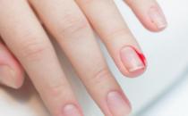 ?倒刺雖小處理不好會出大問題 預(yù)防倒刺有妙招