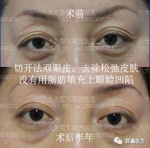 八大處整形郭鑫：上眼瞼凹陷脂肪填充圖片