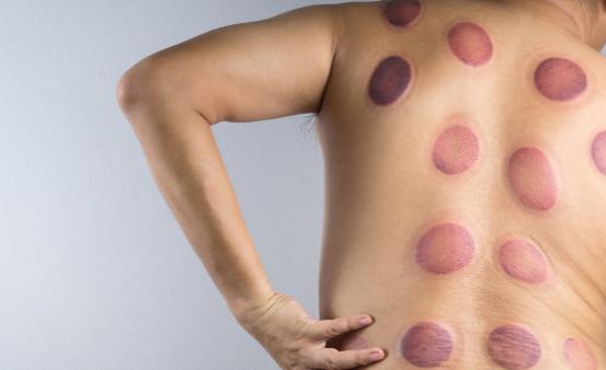 拔火罐減肥能減肥嗎 拔火罐減肥有哪些注意事項(xiàng)