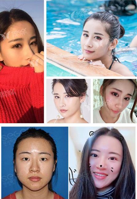 常州曙光美容醫院做眼部整形怎么樣 安全自然定制美麗