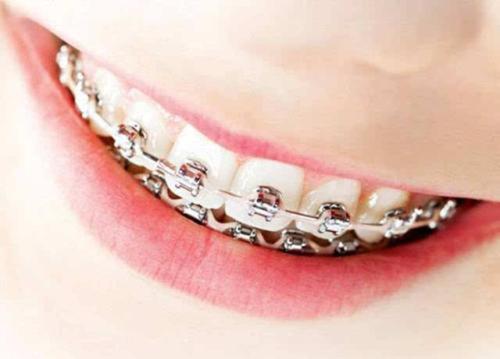 武漢德韓口腔揭秘關于牙齒矯正方案那些事兒