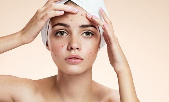 臉上痘痘多影響個人顏值 14個偏方輕松甩掉痘痘