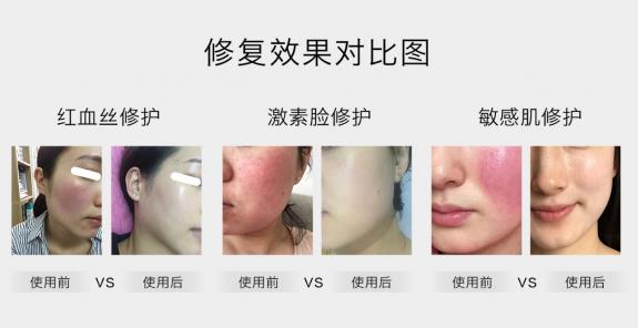 放心！有美薏升修復(fù)敏感肌紅血絲專家產(chǎn)品在，你每天都可以美美噠