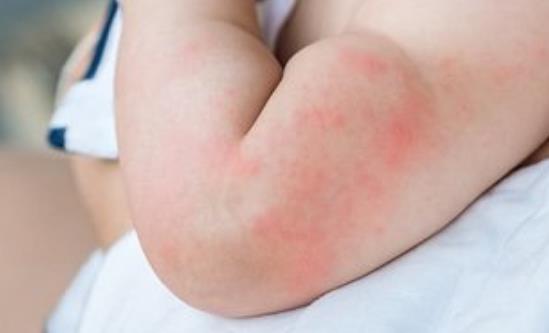 蕁麻疹影響生活工作 蕁麻疹的治療方法