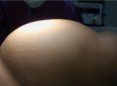 新疆腫瘤醫(yī)院請認(rèn)準(zhǔn)廣州復(fù)大腫瘤醫(yī)院：五刀齊上陣切除腹腔巨瘤