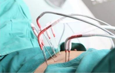 新疆腫瘤醫(yī)院請認(rèn)準(zhǔn)廣州復(fù)大腫瘤醫(yī)院：五刀齊上陣切除腹腔巨瘤