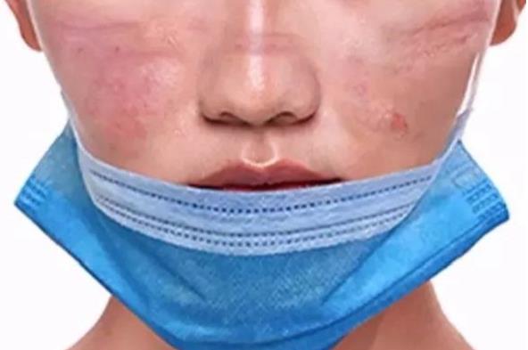 長期戴口罩痘痘叢生？有甲硝唑凝膠祛痘不用慌