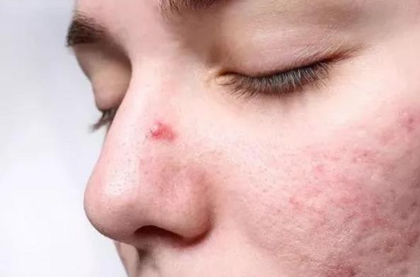 長期戴口罩痘痘叢生？有甲硝唑凝膠祛痘不用慌