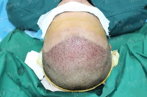 青島大麥微針植發2500毛囊單位，術后8個月恢復頭發濃密