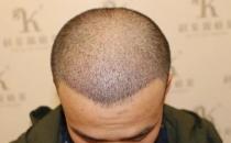 青島大麥微針植發2500毛囊單位，術后8個月恢復頭發濃密