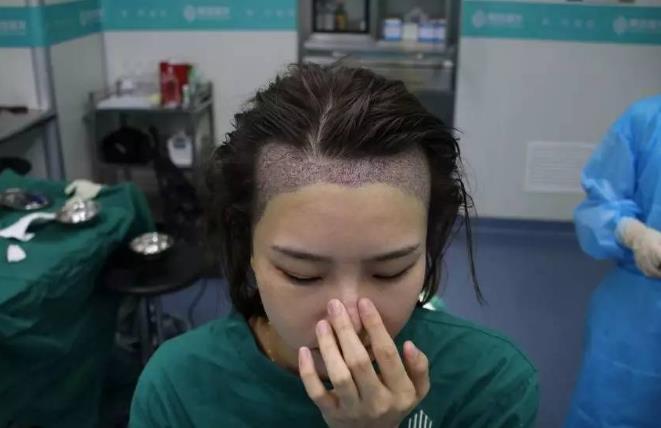 為什么植發效果相差半邊天？廣州青逸植發醫院專家透入原因居然是……