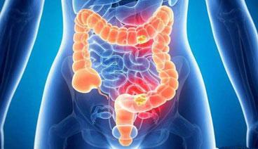 昆明東大肛腸醫院提醒:腸癌高發這六類人腸鏡檢查費用一定不能省