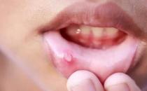 ?嘴角起小水泡怎么回事，嘴角起了一堆小水泡怎么辦