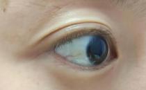 ?眼白發黃是怎么回事(眼白發黃是怎么回事有紅血絲)